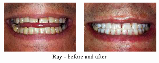 Tooth Whitening before and after 