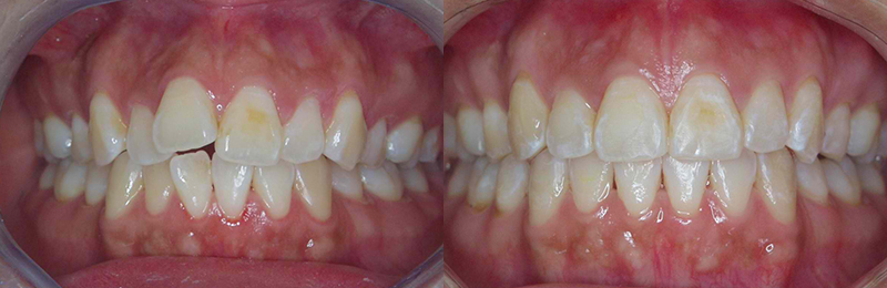 Invisalign before and after