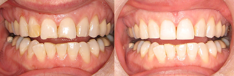 These bonded resin composites were placed without the need for any anesthesia