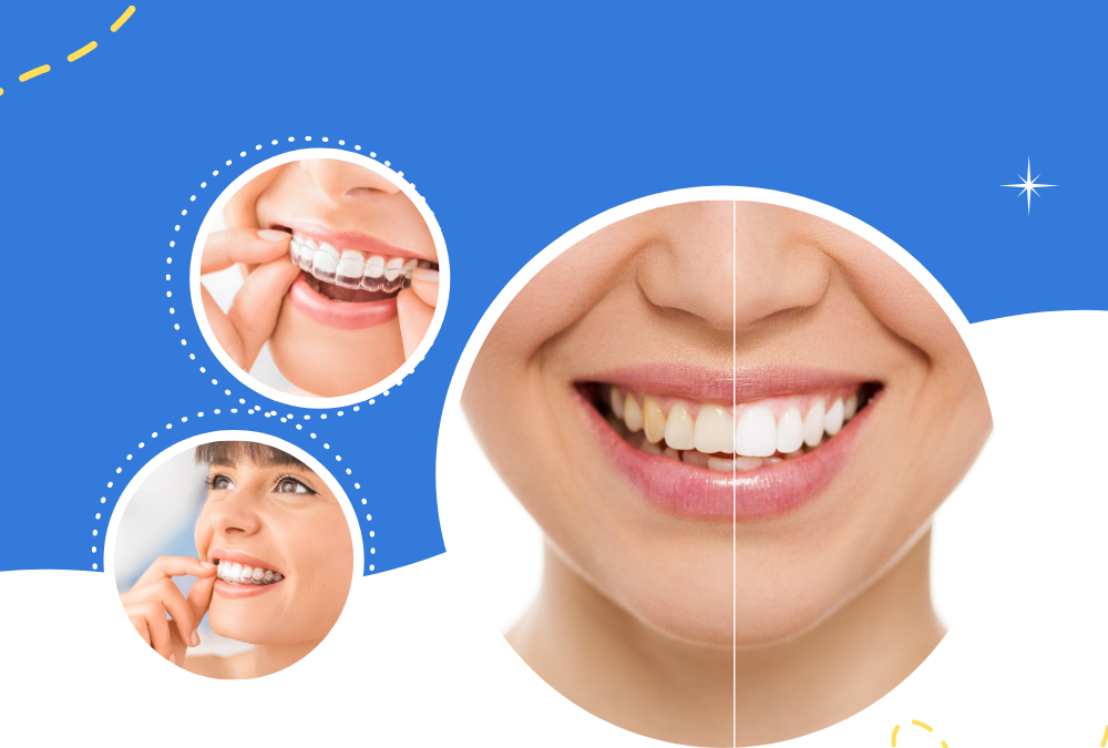 Teeth Whitening – Frequently Asked Questions